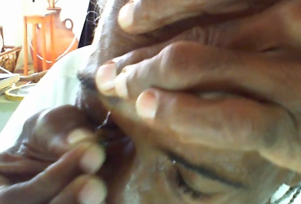Bee sting forehead inflamation 2