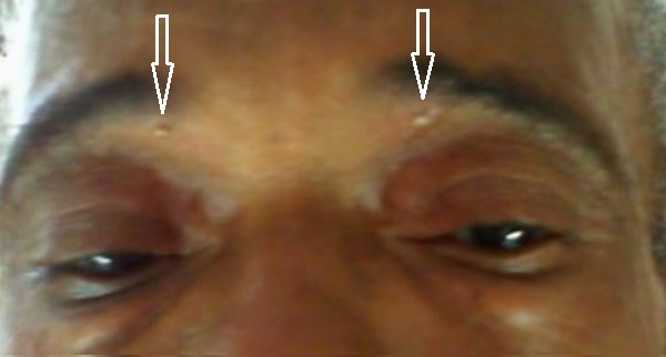 Bee sting forehead inflamation post